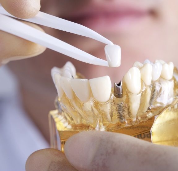Dentist placing dental crown on model of dental implant
