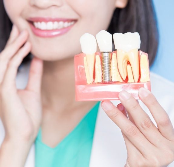 Dentist holding model of dental implant in the jaw