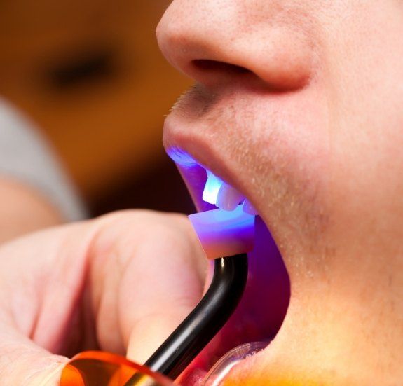 Close up of dental patient receiving cosmetic dental bonding