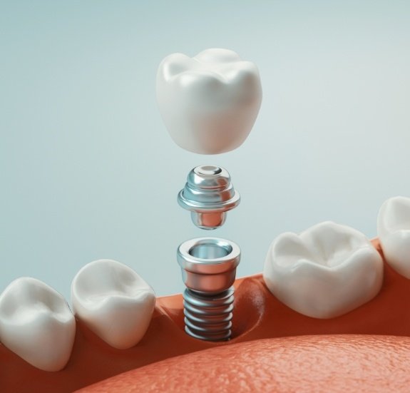 Illustrated dental implant being placed in lower jaw