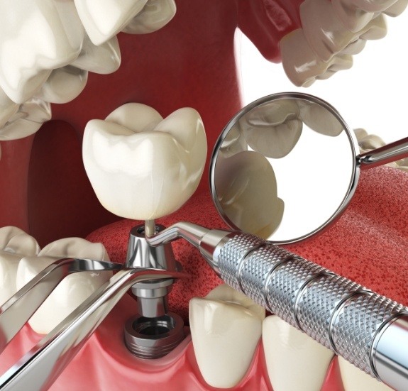 Illustrated dental implant with abutment and crown being placed in the mouth