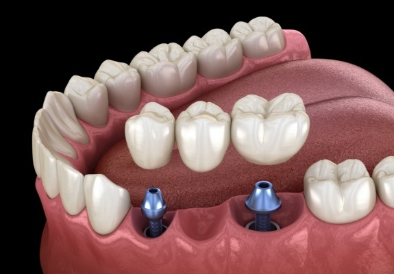 Illustrated dental bridge being placed onto two dental implants