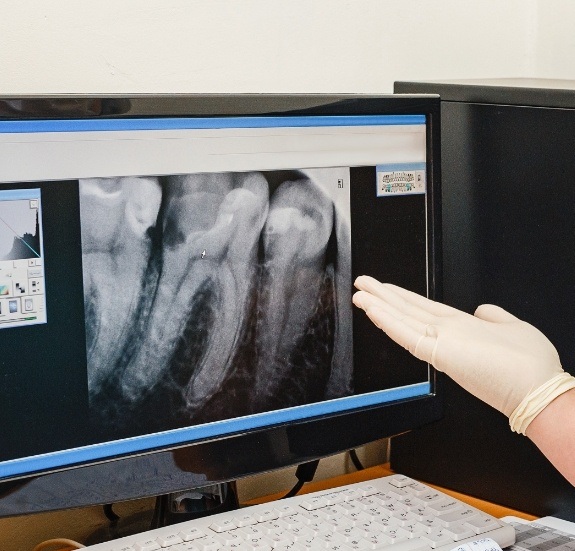 Dentist gesturing to digital x rays of teeth on computer screen