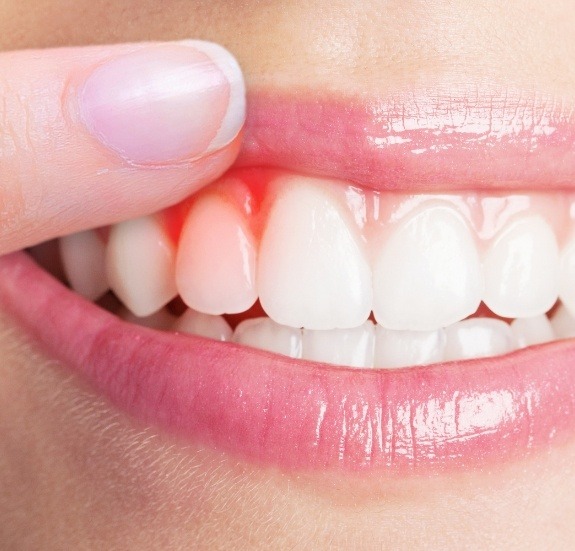 Close up of person pointing to red spot in their gums