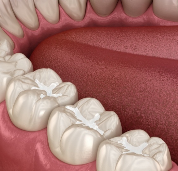 Close up of illustrated row of teeth with dental sealants