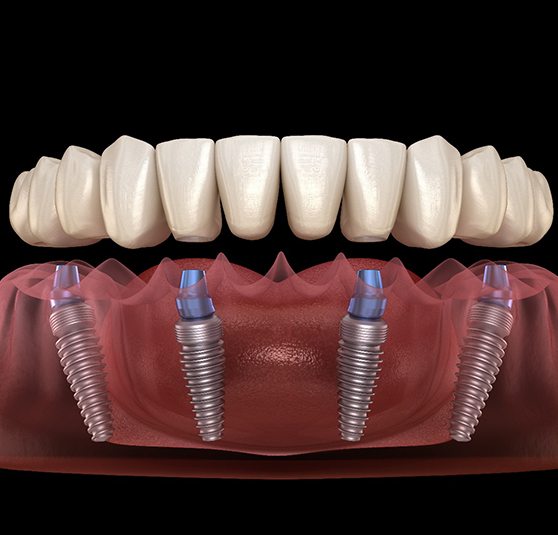 Digital image of full arch implant restorations on the lower arch