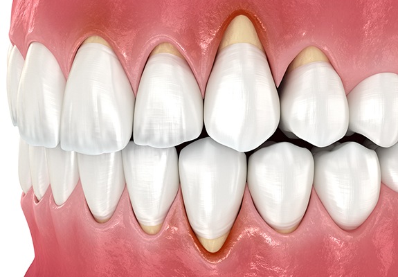Digital image of gum recession