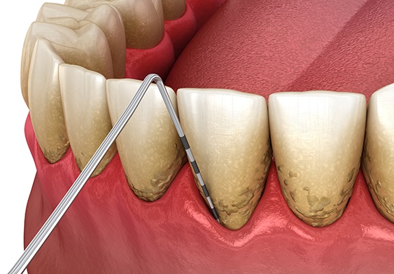 Digital image of scaling and root planing process