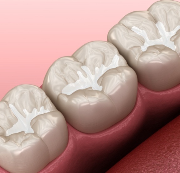 Close up of illustrated teeth with tooth colored fillings