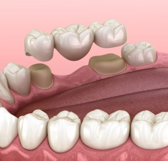 Illustrated dental bridge being fitted to replace a missing tooth