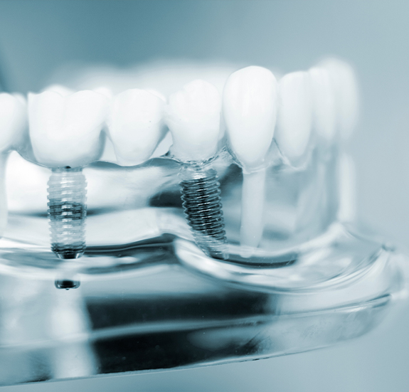 Model of the mouth with two dental implants in lower jaw